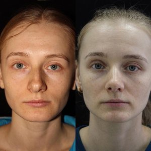 Открытая ринопластика изменила форму носа девушки и восстановила дыхание Фото 4